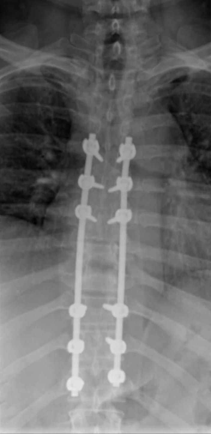 X-ray of Corey's spine after surgery, showing the bards and screws put in.