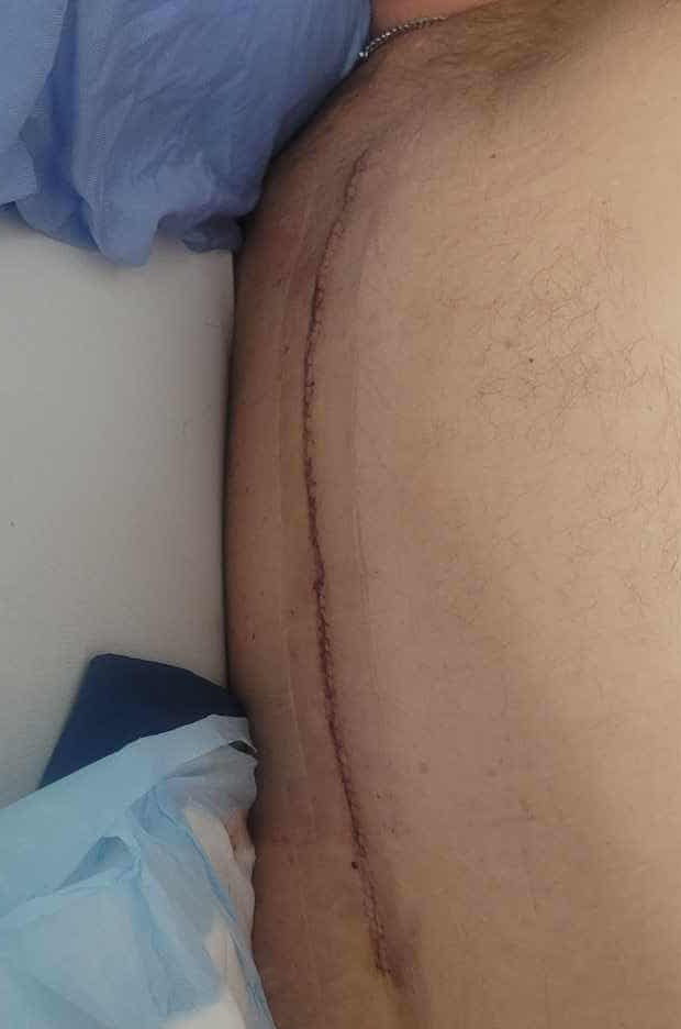 Close up of Corey's spinal surgery scar.